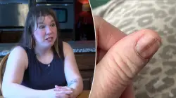 Mom credits TikTok video for life-saving cancer diagnosis after spotting strange nail marking